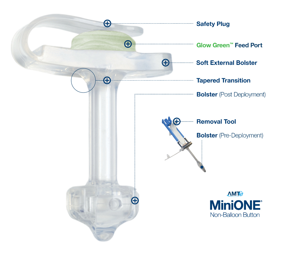 Applied Medical Technology|MiniONE<sup>®</sup> Non-Balloon