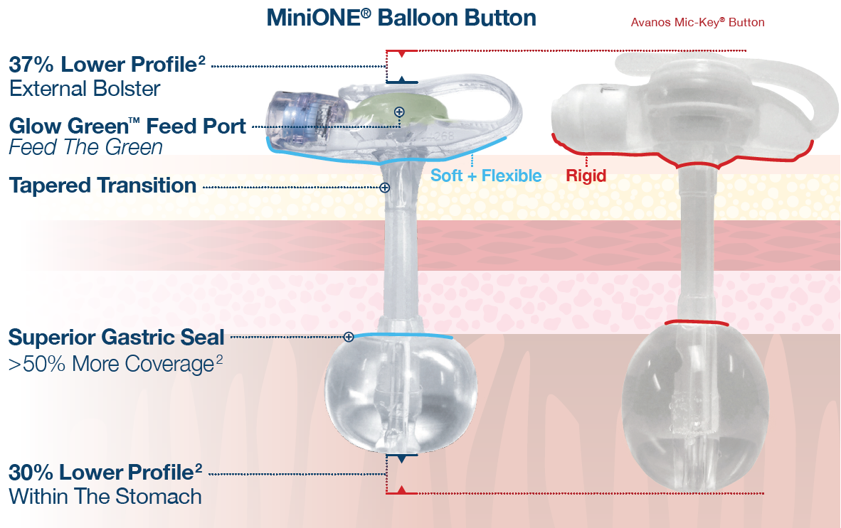 Applied Medical Technology|MiniONE<sup>®</sup> Balloon