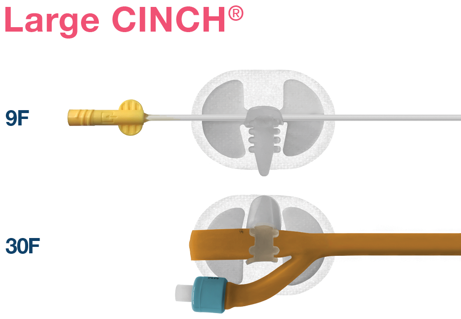 Applied Medical Technology|CINCH<sup>®</sup>